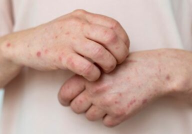 skin allergy hands