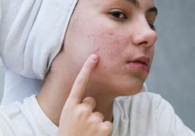 teenage girl skin problem