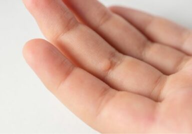 wart finger close up