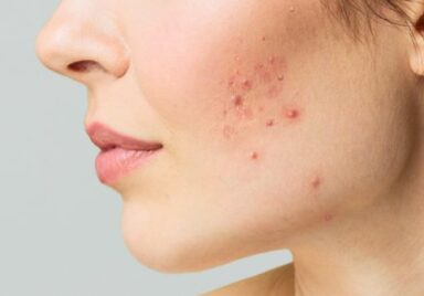 young woman with acne face